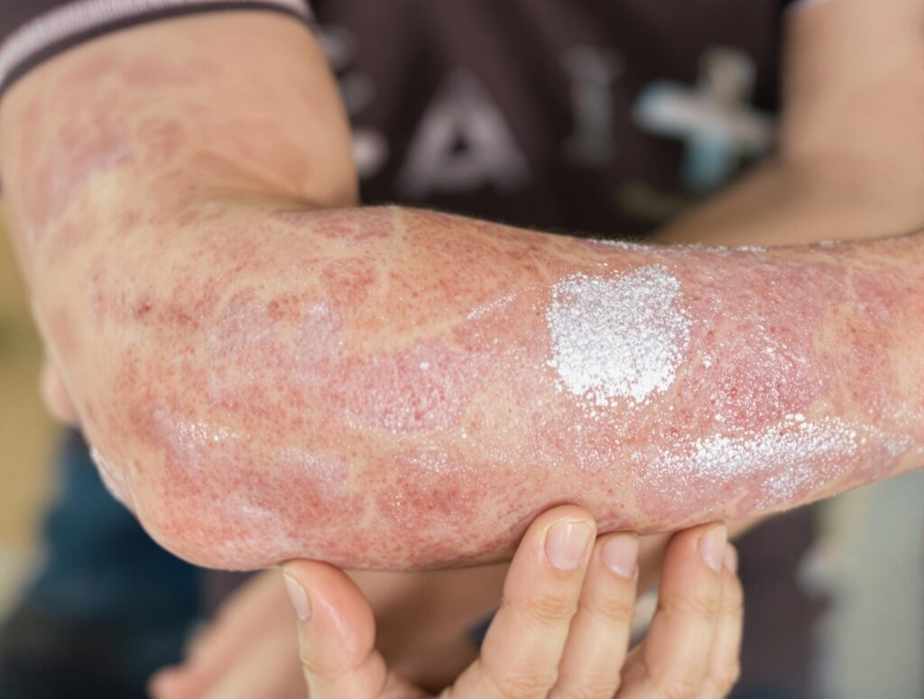 Zblízka pohled na loket s lupénkou