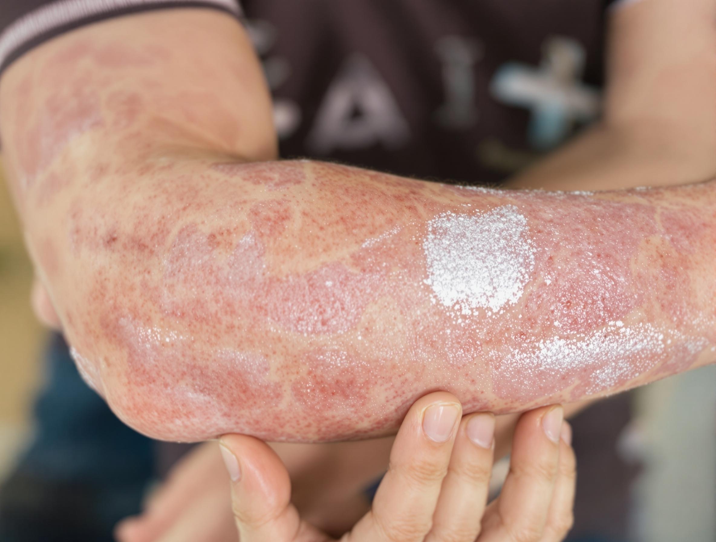 Zblízka pohled na loket s lupénkou